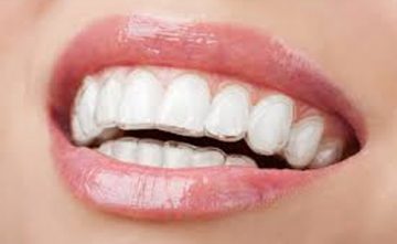 Invisalign-Clear-Braces