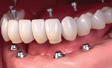 dental_implants