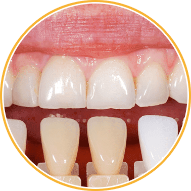 Porcelain-Veneers