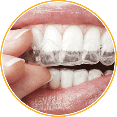 invisalign