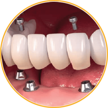 Implant Bridge