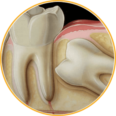 Wisdom Tooth Removal